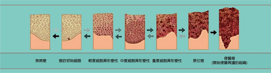 形成惡性腫瘤前的細胞變異過程（source：NCI Division of Cancer Prvention）